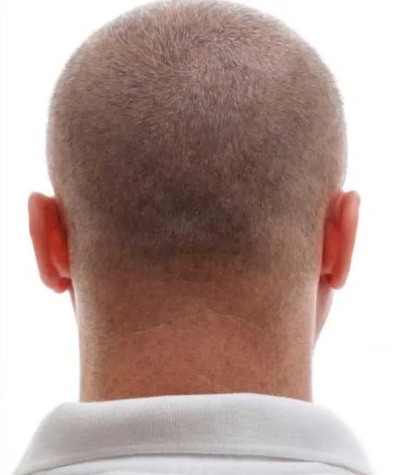 زراعة الشعر - بعد
