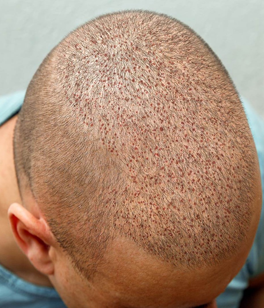 زراعة الشعر - بعد