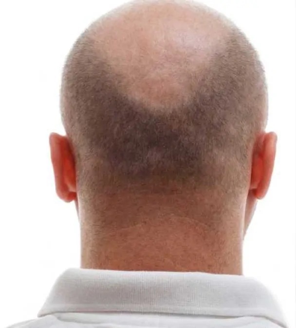 زراعة الشعر - قبل