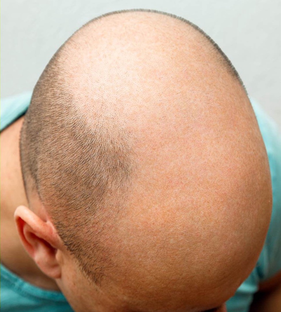 زراعة الشعر - قبل