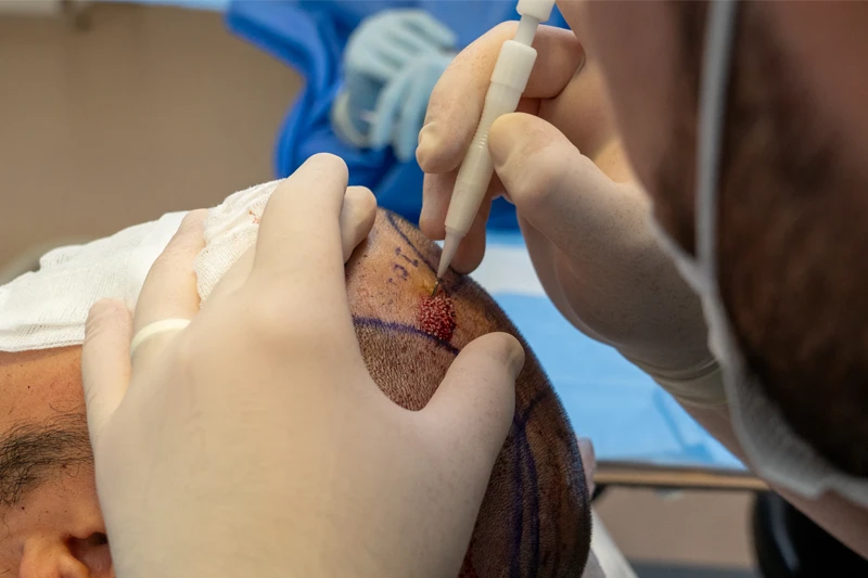 زراعة الشعر بتقنية DHI