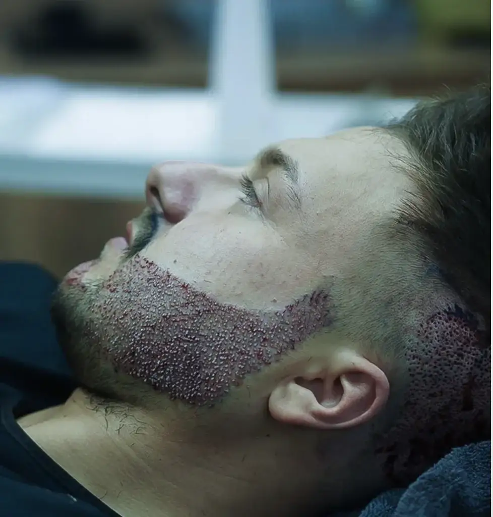 beard-transplant