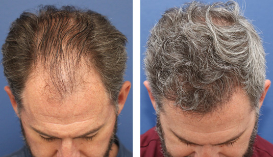 زراعة الشعر للرجال في آيكونا كلينيك