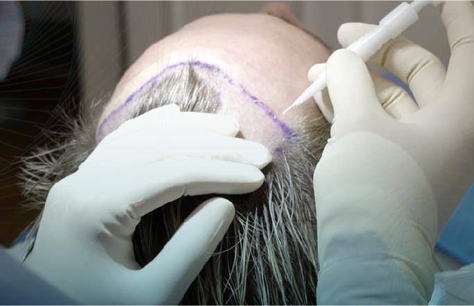 فحوصات ما قبل زراعة الشعر في آيكونا كلينيك
