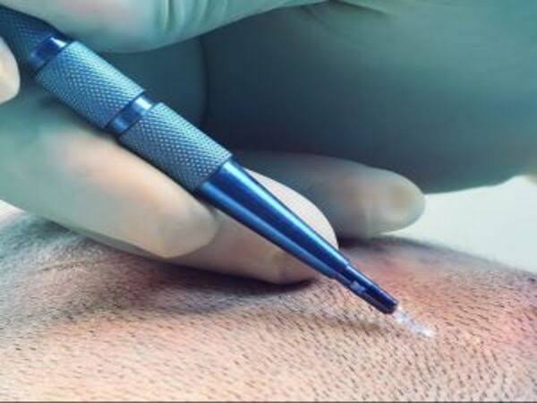 زراعة الشعر بتقنية السفير في إسطنبول