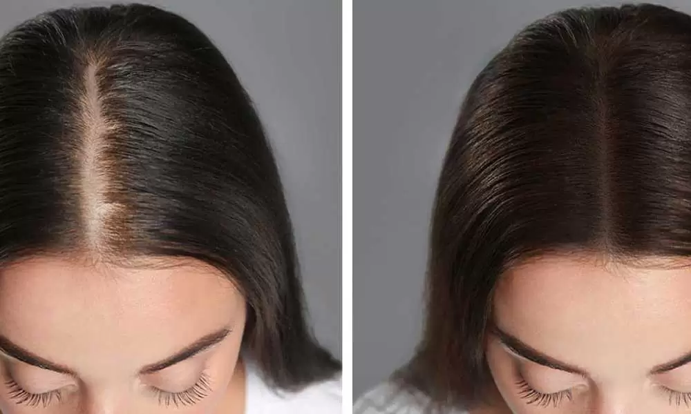 زراعة-الشعر-للنساء-قبل-وبعد.jpg