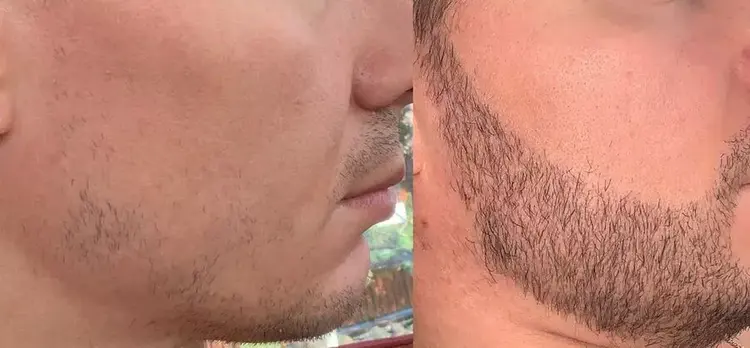 زراعة شعر اللحية في آيكونا كلينيك