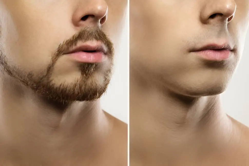 زراعة-شعر-لحية-1.jpg