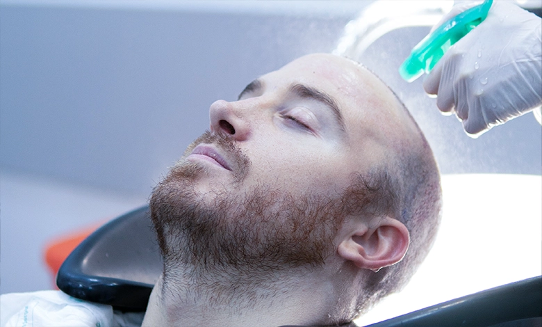 العناية بعد زراعة الشعر في آيكونا كلينيك